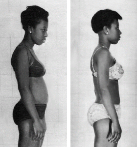 Before and After Rolfing Body Alignment Transformation at Center of Integration in Tampa